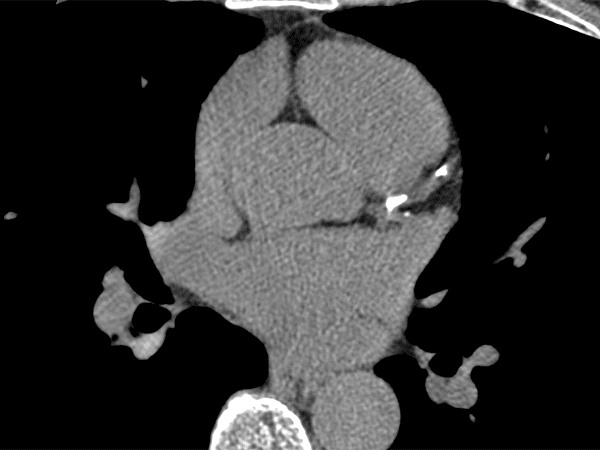 CAC test image with calcifications seen in the coronary arteries, Bangkok, Thailand