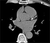 Coronary Artery Calcium CT in Bangkok